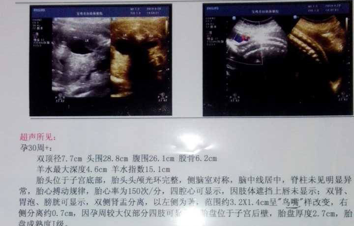 羊水少了怎么办？这个时期很重要