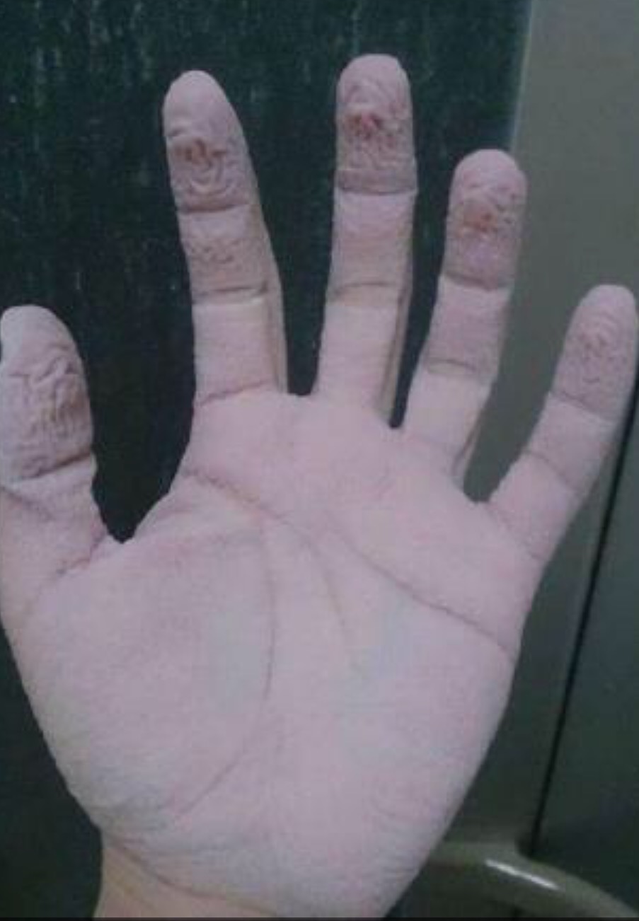 洗澡时间久了手皱是怎么回事,洗完澡手上有褶皱有什么危害吗