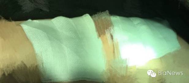 刮痧刮破皮了可要求多少赔偿,刮痧刮掉皮了