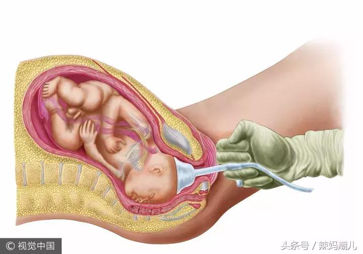 双胎孕晚期怎么预防宝宝早产,孕晚期应该怎么预防早产