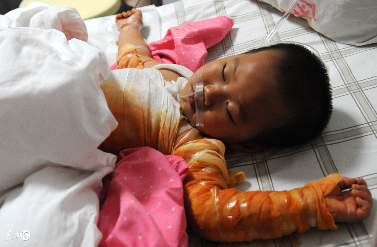 揪心小孩烫伤,宝宝被开水烫伤起了一层红疤