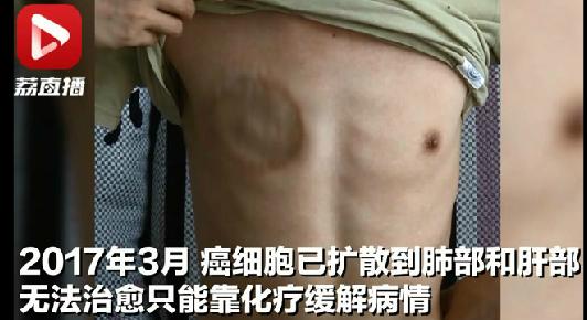 一颗黑痣流血没理会，33岁年轻爸爸癌细胞扩散已无法治愈！