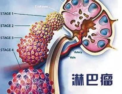 高仓健患淋巴瘤,高仓健淋巴瘤
