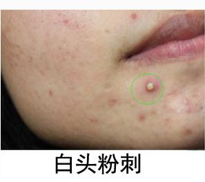 痘痘里面挤出来的白色东西是什么,痘痘挤出来白色硬粒后再挤出血