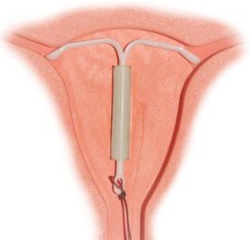 避孕环安静子宫里为什么不会脱落,避孕环怎样才可以自己脱落