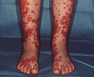 过敏性紫癜是一种什么病严重吗,过敏性紫癜会和荨麻疹同时发病吗