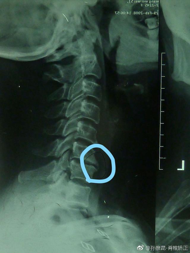 重庆治疗颈椎病最好的医院,治疗颈椎病的锻炼方法视频