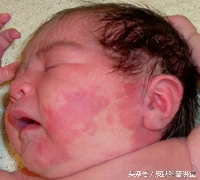 鲜红斑痣和新生儿红胎记区别,激光染料治疗网状鲜红斑痣的效果