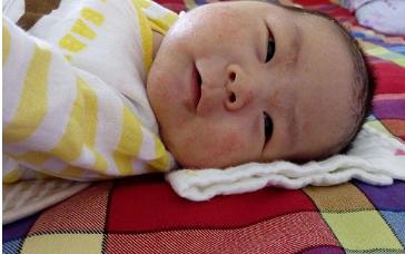 纯母乳宝宝湿疹加腹泻怎么回事,宝宝肚子上湿疹的最佳治疗方法