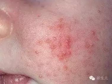 新生儿宝宝红疹子怎么引起的,新生儿皮肤起红疹子怎么办