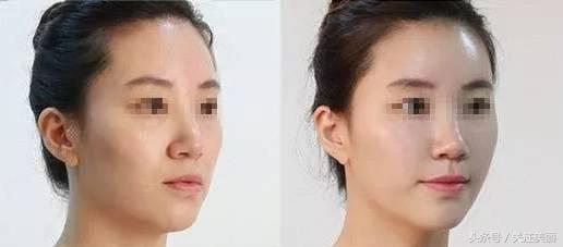 玻尿酸有什么效果呢,玻尿酸对皱纹有疗效吗