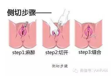 顺产妈咪最怕什么,侧切剖腹产孕妇要注意什么