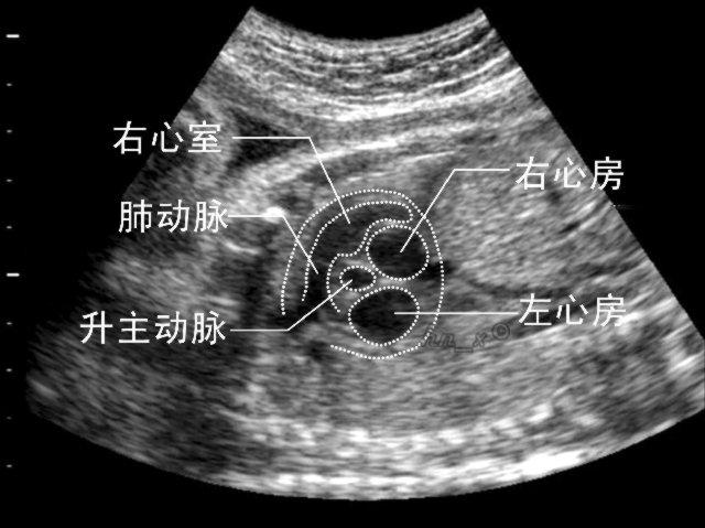 了解胎囊、胎芽、胎心到底是什么？