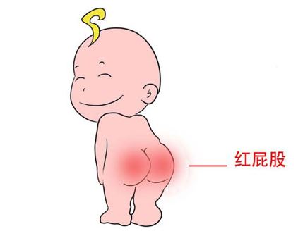 防宝宝屁股红神器,宝宝防红脖子红屁屁专用