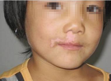 白癜风治好的真实案例,真实有效治白癜风中医