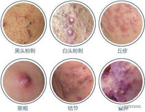 朵嘉浓祛痘凝胶好不好,朵嘉浓闭口粉刺