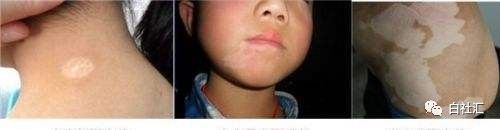 后天的白癜风会不会扩散,白癜风冷冻后能恢复吗