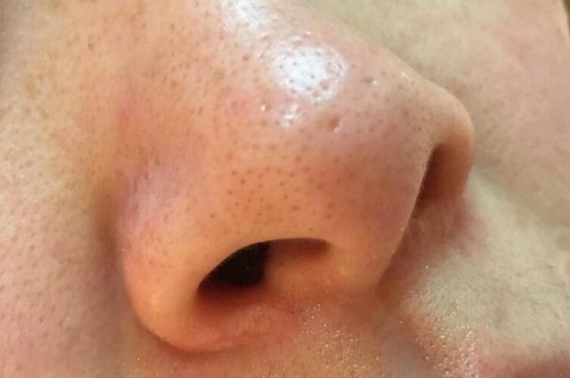 补锌与痘痘,补锌能缓解痘痘的生长吗