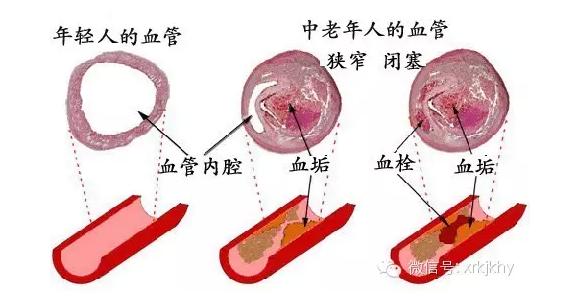 血管堵没堵看这里就知道了,吃肥肉容易堵血管吗