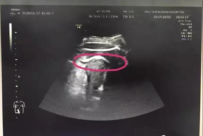 胎动会不会把子宫踢破,怀孕8月胎动不明显