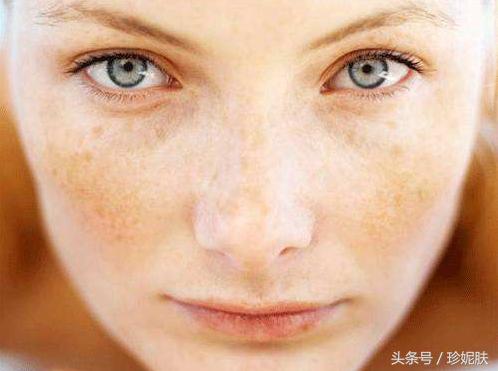 褐斑和黄褐斑一样吗,黄底褐斑