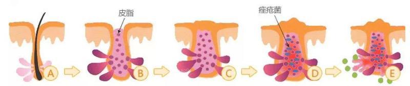 粉刺没有处理好变成硬疙瘩,痘痘粉刺消不掉