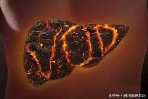 医生说肝上火,肝上火总是发脾气