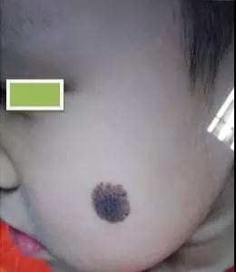 身上的黑痣什么情况下要去检查,身上的黑痣要不要去除