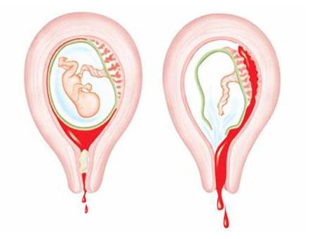 孕期先兆流产有哪些症状,孕期有先兆流产症状要注意哪些