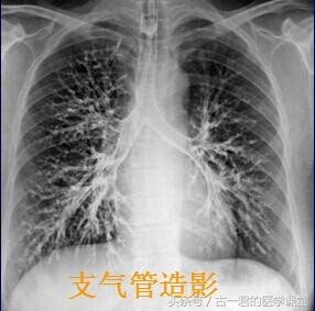 支气管扩张是大病吗,支气管扩张