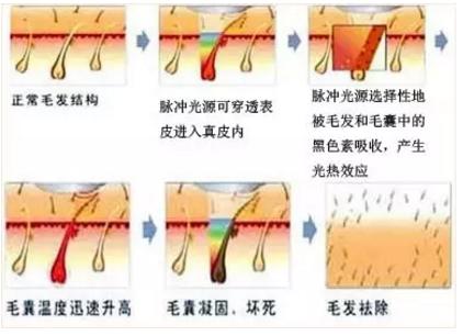激光永久脱毛可以脱胡子吗,激光脱毛一般要用几次才能祛干净