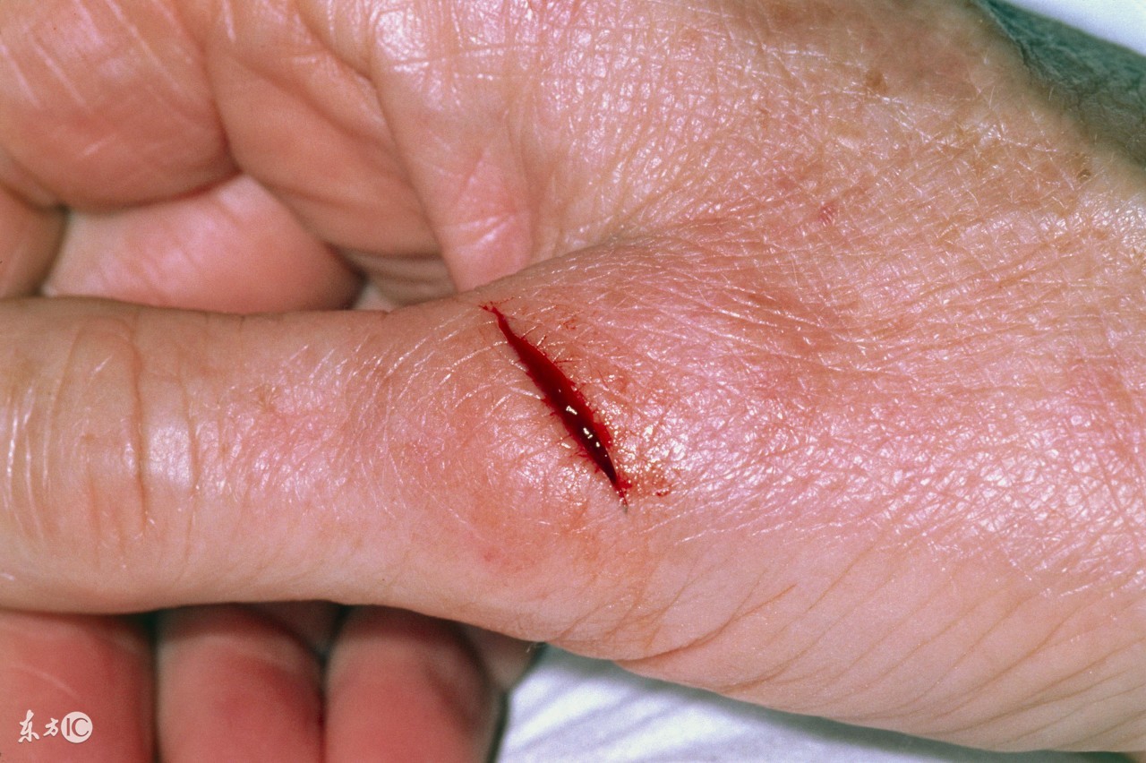 被刺伤需要打破伤风吗,被刀割伤后多久打破伤风有效