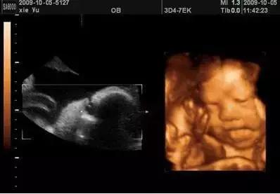 普通b超和彩超哪个辐射小点,普通的彩超和孕妇b超有区别吗