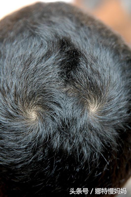 关于宝宝头上旋的说法,宝宝头上的旋能决定智商吗