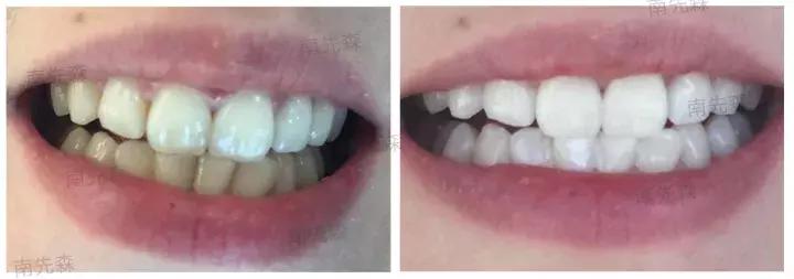 美容冠美白,一周快速脸部美白小妙招