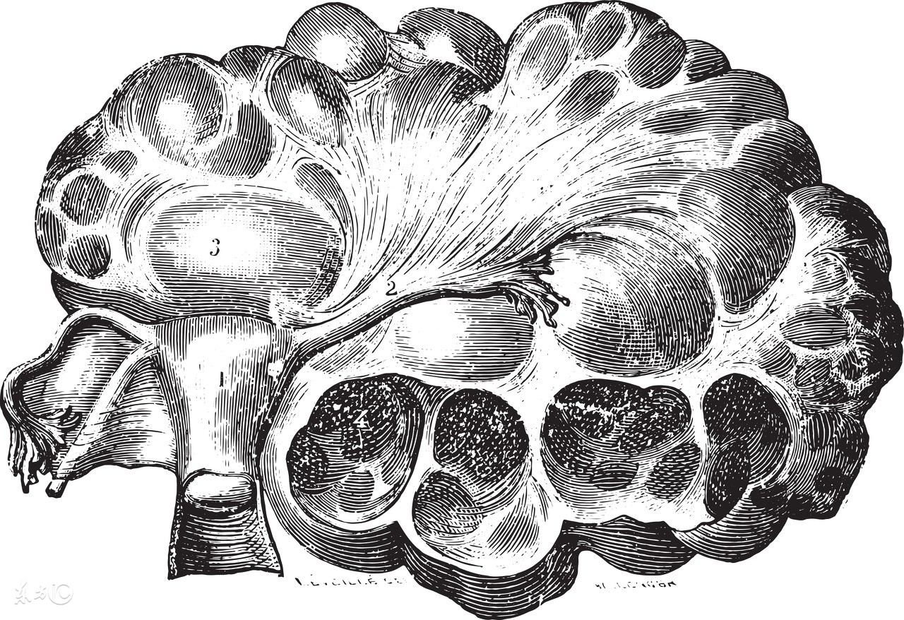 如何更清楚的了解子宫囊肿的发病原因