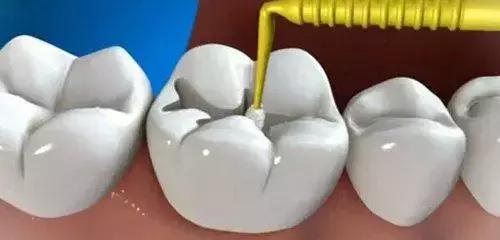 牙齿摔倒掉了一半补牙全过程,一颗牙齿脱落补牙