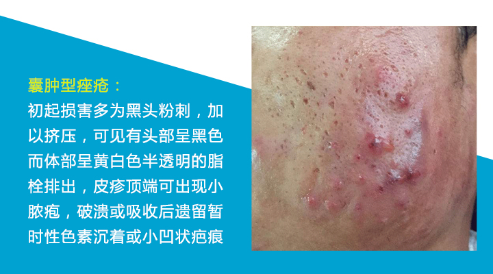 八种痘痘,九大部位的痘痘