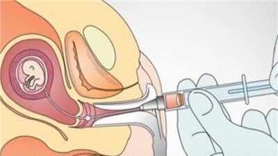 怀孕期间怎么避免唐氏儿,如何避免唐氏儿