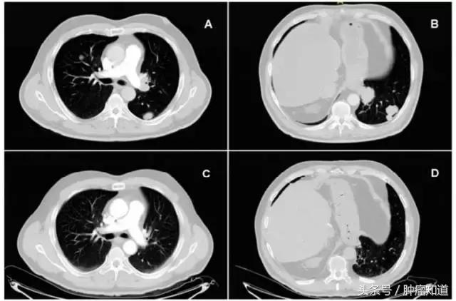 涓栫晫棣栦緥cart鐤楁硶娌绘剤鑲濈檶,涓栫晫绗竴渚媍art娌绘剤鏅氭湡鑲濈檶