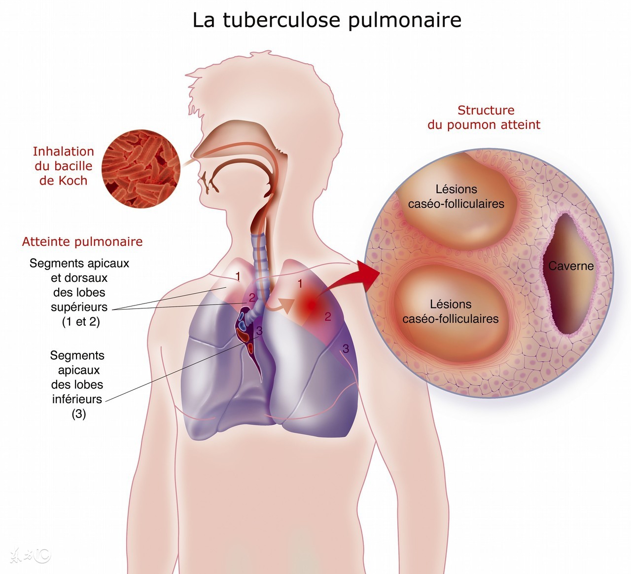 呼吸系统感染吃什么药,呼吸系统感染首选哪种抗生素