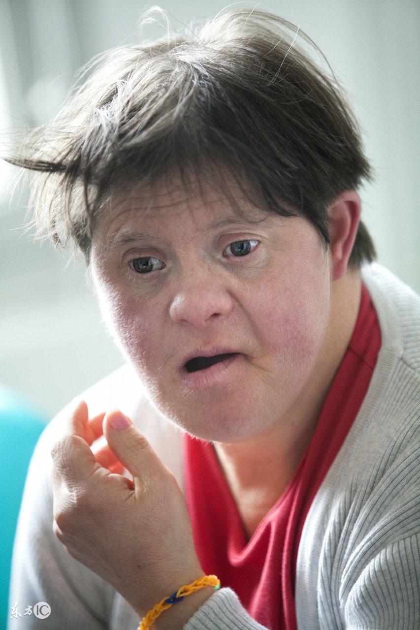 McCuneAlbright综合症,McCuneAlbright综合征