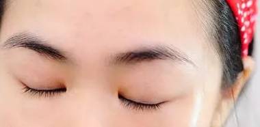 有黑眼圈细纹脂肪粒怎么办,去黑眼圈脂肪粒最有效的方法