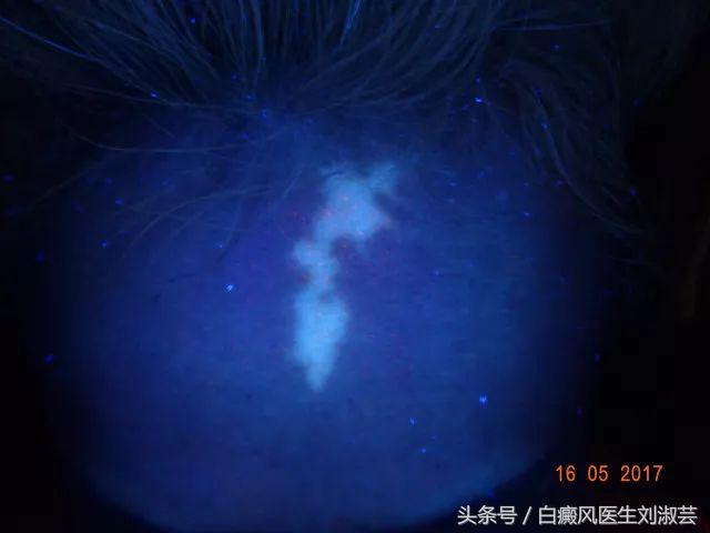 白斑病患者自述,白斑患者图片