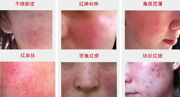 敏感肌修复瑞玲老师8000肤诊案例连载004-激素脸老是反复怎么办