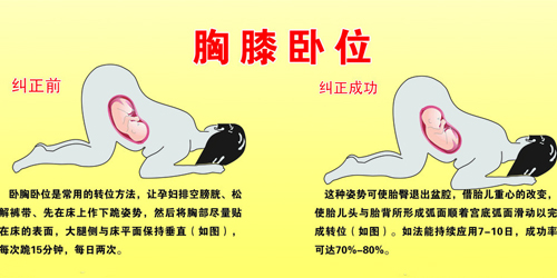 胎位不正艾灸纠正的最佳时间,胎位不正用艾灸纠正方法视频