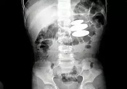 儿童误吞异物抢救视频,宝宝误吞异物大便有什么表现