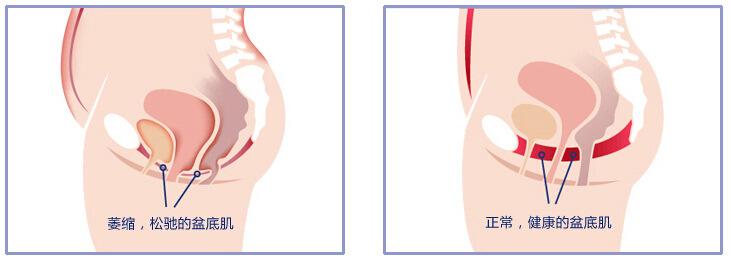 产后修复，不仅只有瘦瘦瘦