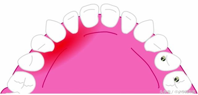 怀孕期间孕妈妈的口腔问题,孕妇注意口腔健康宣教内容