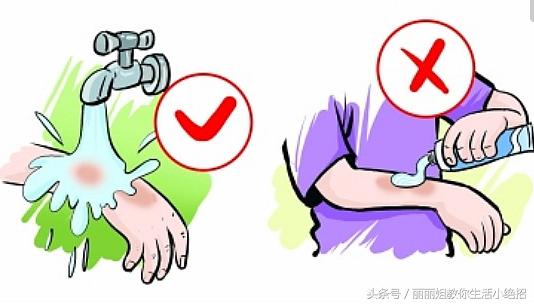 如果在家不小心被烫伤可以怎么办,不小心烫伤要怎么样才可以不烫